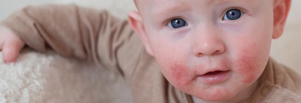 calendula cream for perioral dermatitis