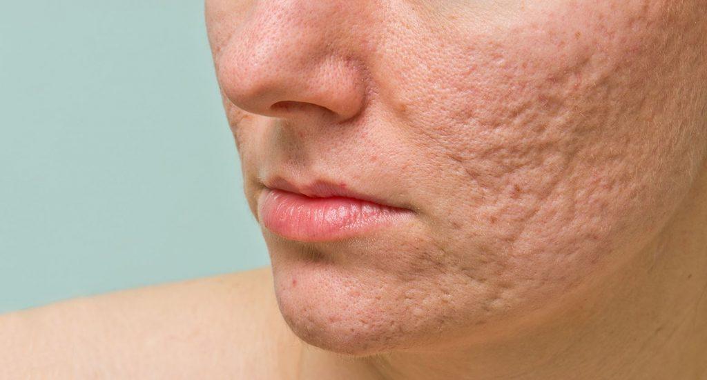 can botox help acne scars