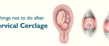 Things Not to do After Cervical Cerclage