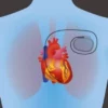 Life with a Pacemaker: Answers to Common Patient Questions