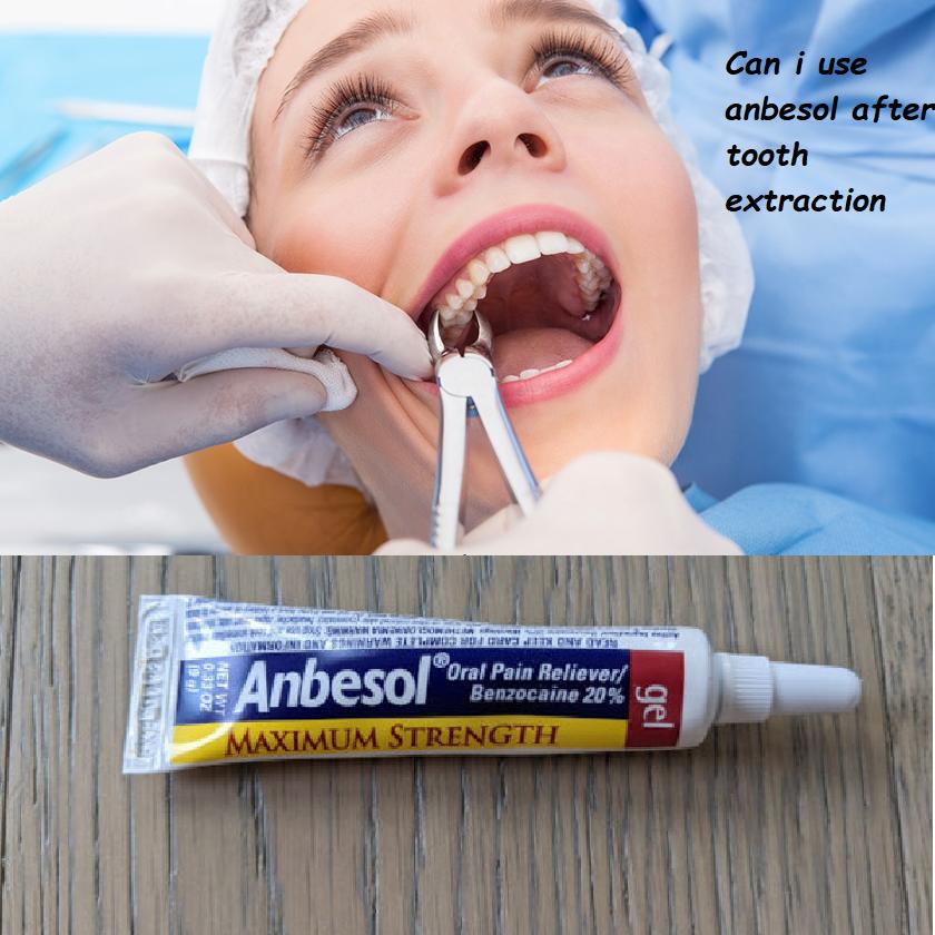 can i use anbesol after a tooth extraction