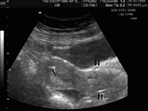 Sperm suspension is a highly ultrasonically visible material: a novel model to study uterine activity