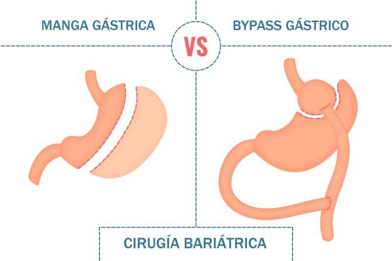 diferencia manga gastrica y bypass