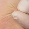 Is that skin bump a wart? How to identify and treat common warts