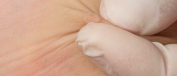 Is that skin bump a wart? How to identify and treat common warts