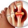 Gout In Depth: Risk Factors, Diagnosis and Treatment