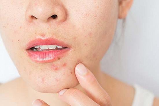 does azelaic acid help perioral dermatitis