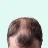 Steroids hair loss