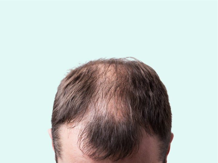 does primobolan cause hair loss