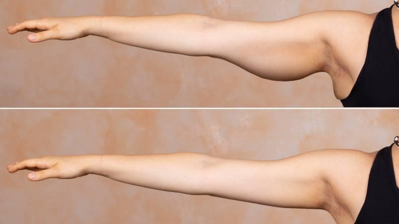 excess arm skin removal cost