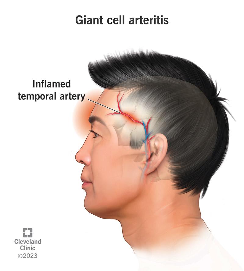 giant cell arteritis life expectancy