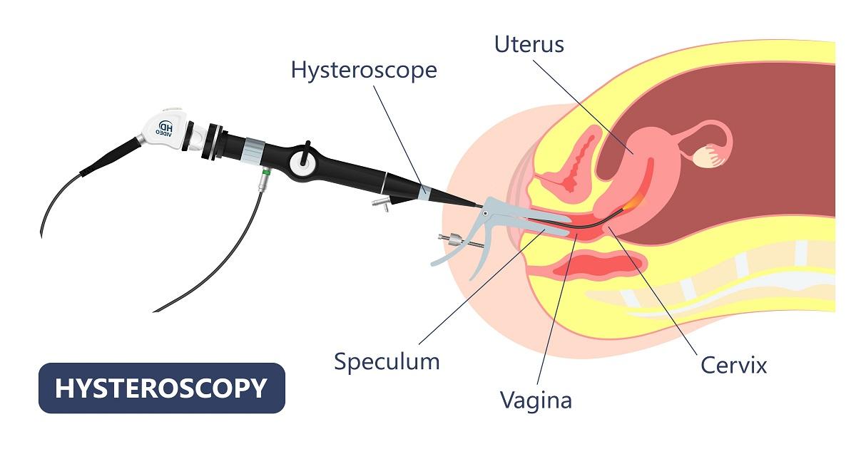 how long to wait for frozen embryo transfer after hysteroscopy