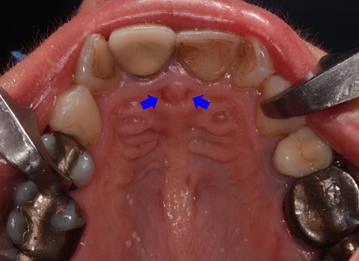 Surgical treatment option of the patent nasopalatine duct: a case report