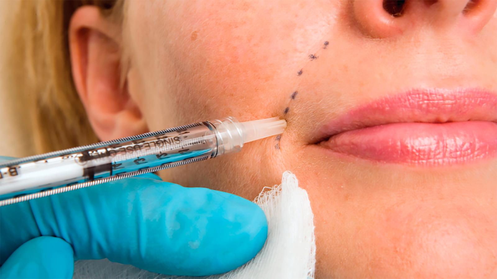 hyaluronic acid fillers smile lines