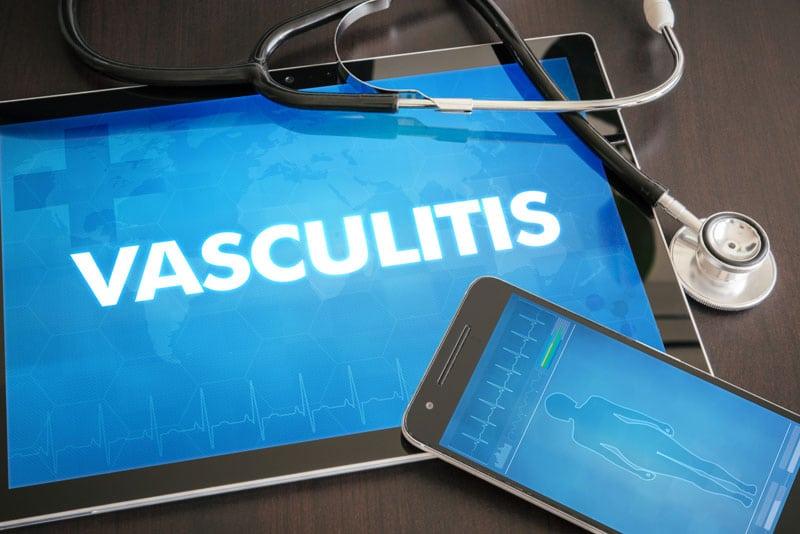 icd-10 code for vasculitis unspecified