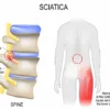 Best brace for sciatica nerve pain