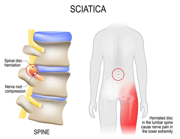 knee brace for sciatica pain