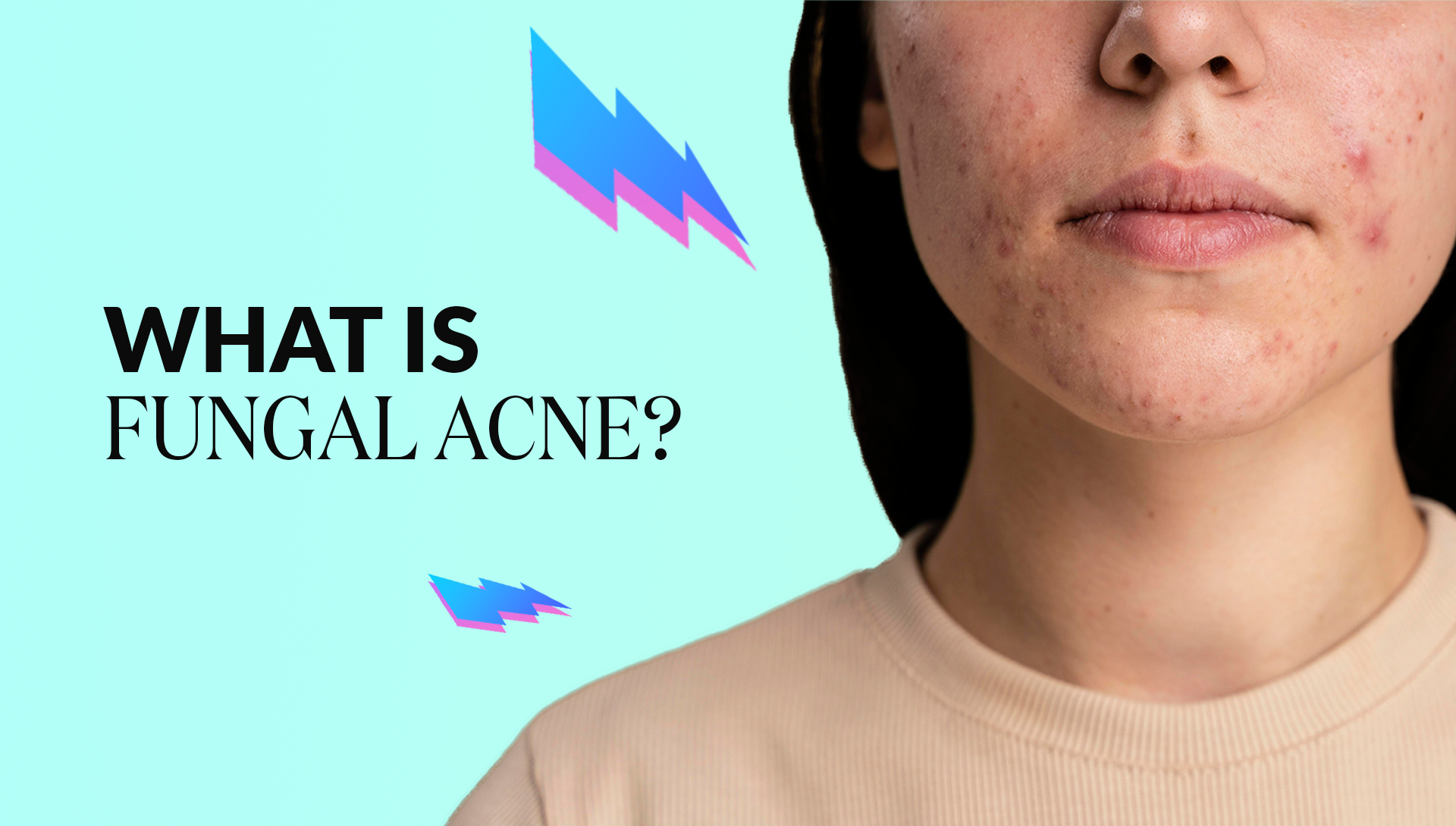 korean skincare for fungal acne