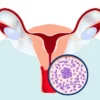 Mixed Urogenital Flora in Urine: Causes, Diagnosis & Impact