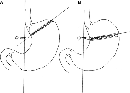 right side back pain after gastric bypass