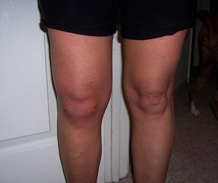 A picture of a knee one week following an arthroscopy (Right knee).