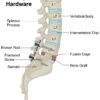 Fractured Spinal Hardware