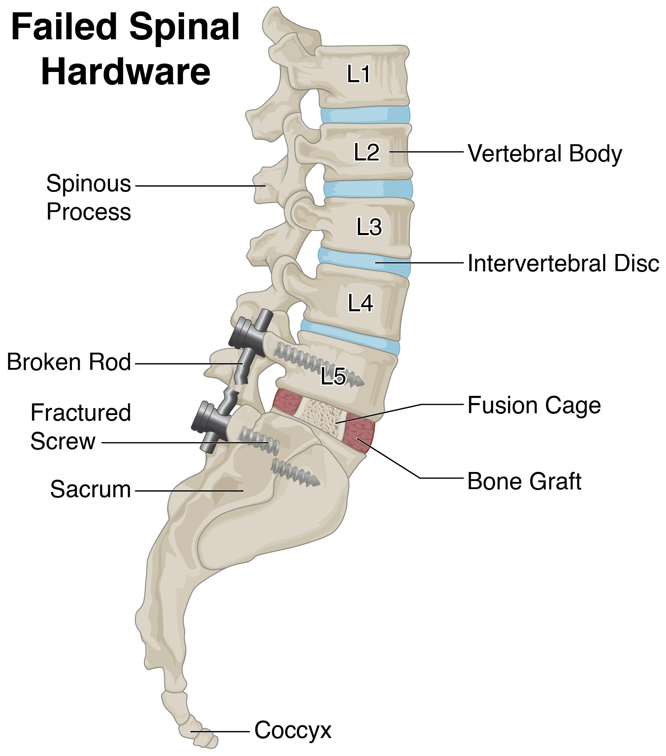 symptoms of broken rod in back