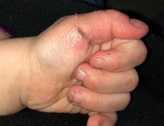 what to put on baby's chapped thumb