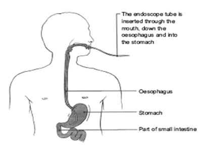 why sore throat after colonoscopy