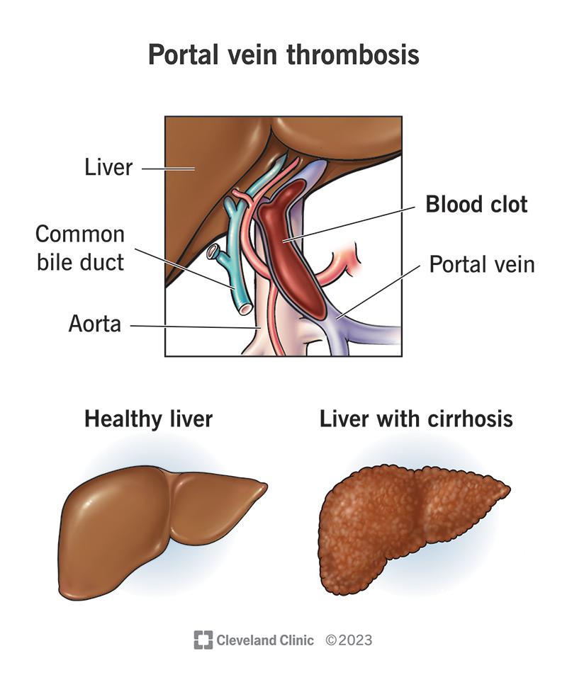 will a liver clot go away on its own